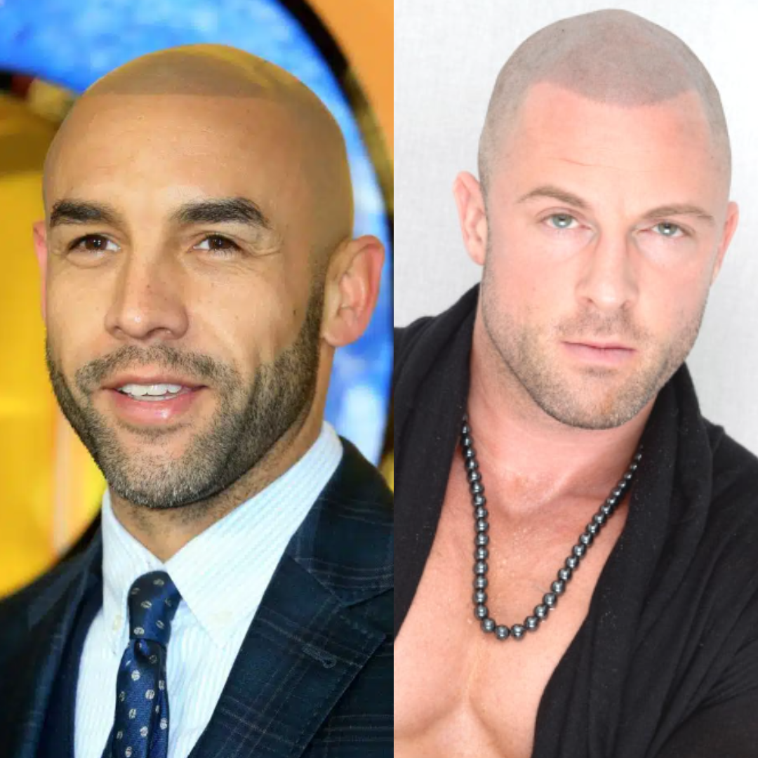 Celebrities With Scalp Micropigmentation (SMP)