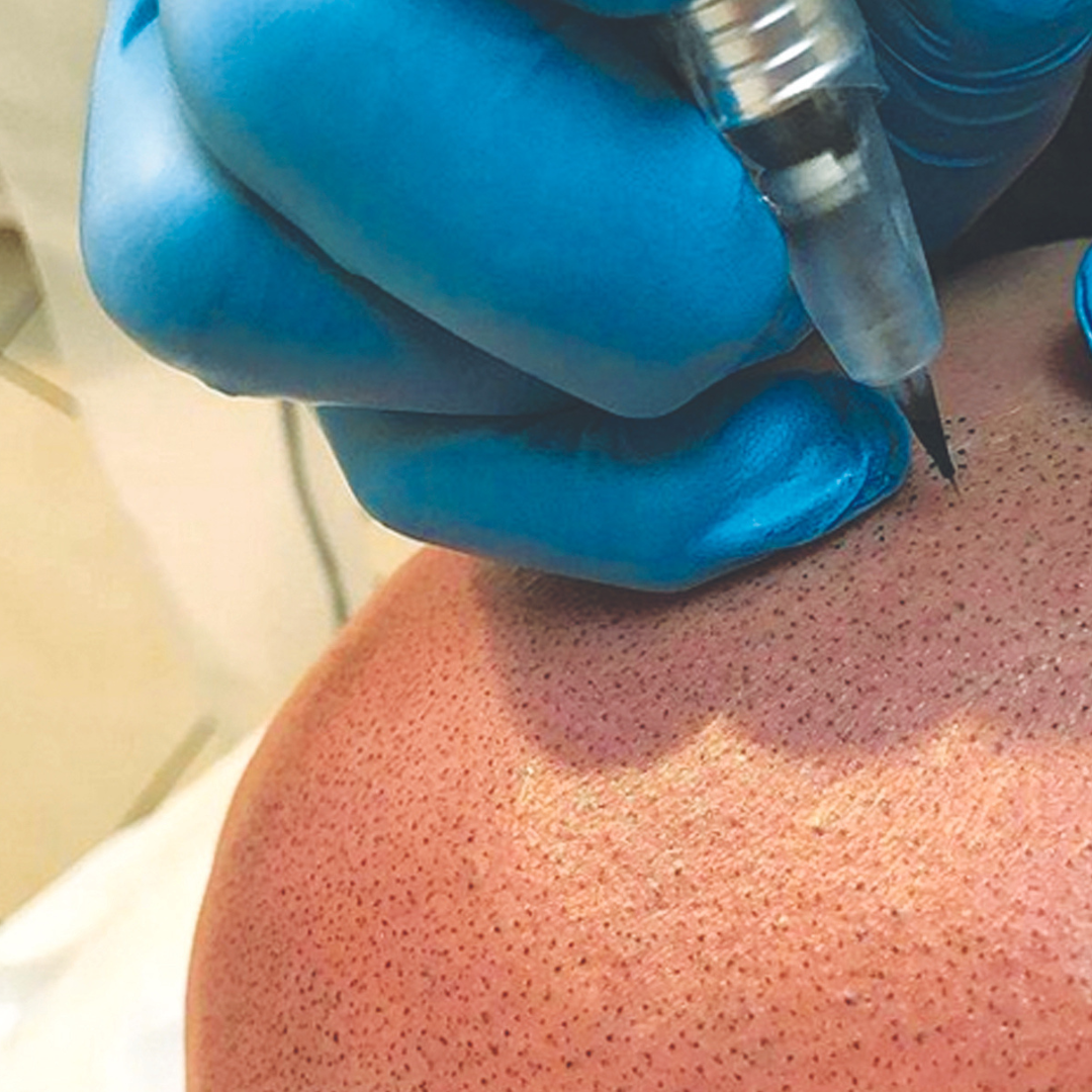 Does Scalp Micropigmentation Fade?